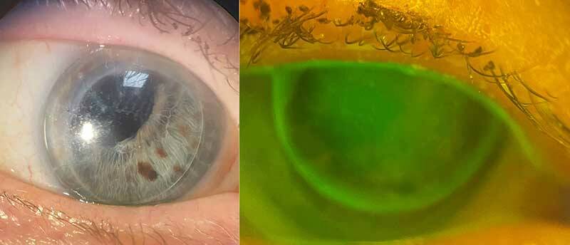 Figure 2. Examen à la lampe à fente avec la LRPG Menicon Rose K2 PG. À gauche : Examen lumière blanche : LRPG en position supérieure, corectopie et atrophie irienne en rapport avec le syndrome ICE. À droite : Examen à la fluorescéine après adaptation ; la lentille est prescrite à l’essai.
