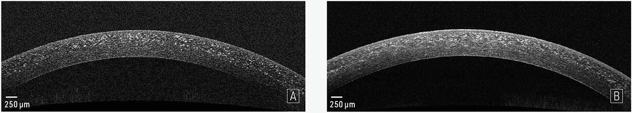 Figure 2. Spectral Domain OCT (Optovue RTVue-100® ; Optovue Inc®, Fremont, Californie, États-Unis).
A. Œil droit et B. Œil gauche : dépôts hyperréflectifs dans l’épithélium, le stroma antérieur et moyen.
