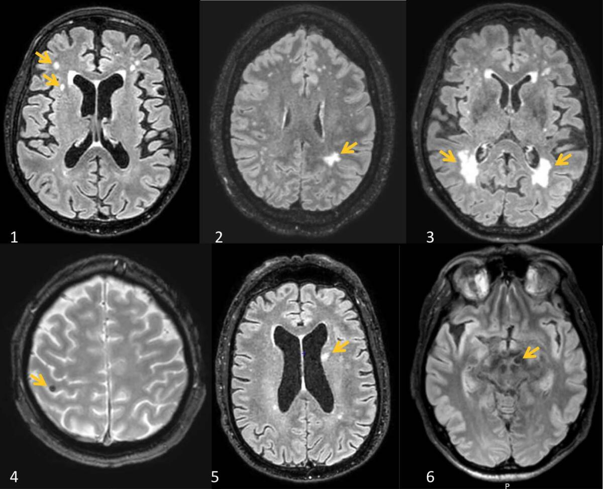 Figure 3. Aspect IRM de la maladie des petites artères cérébrales. En haut, hypersignaux de la substance blanche d’origine vasculaire. 1. Fazekas 1 : les HSSB sont ponctuels non confluants. 2. Fazekas 2 : les HSSB sont confluants dans certaines zones. 3. Fazekas 3 : larges plages d’HSSB. 4. Microsaignement cérébral. 5. Infarctus lacunaire du noyau caudé gauche. 6. Dilatation d’un espace perivasculaire dans le pédoncule cérébral gauche.&nbsp;
