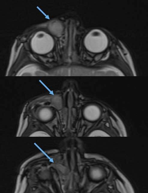Figure 2. Sablier lacrymal : communication des cavités nasale et canthale droites avec plaquage du cornet nasal inférieur vers le septum nasal – IRM en coupe axiale et séquence T2.
