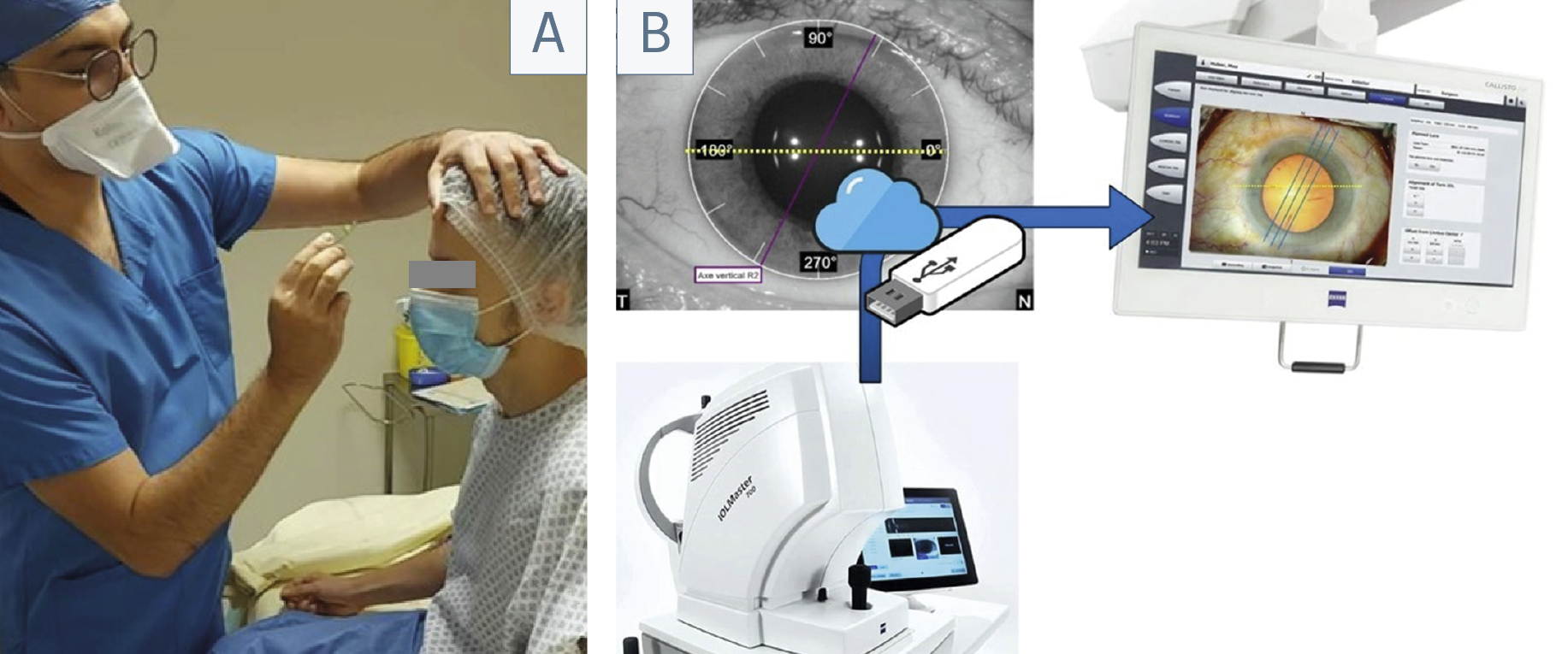 Figure 2. A. Avant, un marquage manuel à niveau à bulle était nécessaire juste avant l’entrée du patient en salle opératoire, étape chronophage et peu fiable. B. Désormais, l’image préopératoire acquise lors de la biométrie est automatiquement transférée au microscope opératoire, qui identifie l’axe 0‑180° sans marquage préalable. Ce guidage numérique permet une implantation torique plus rapide et plus précise.
