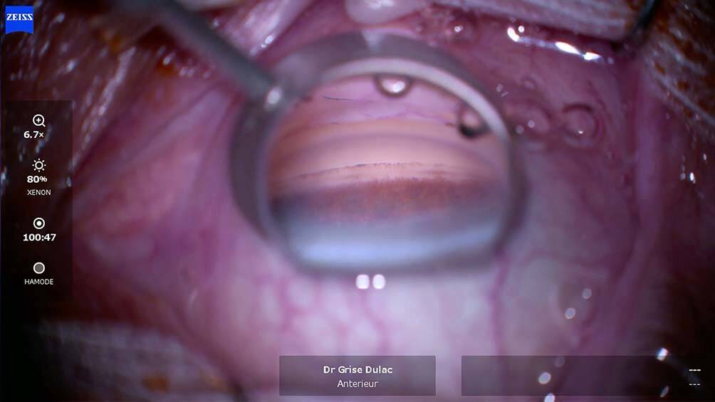 Figure 6. Visualisation gonioscopique au bloc opératoire.
