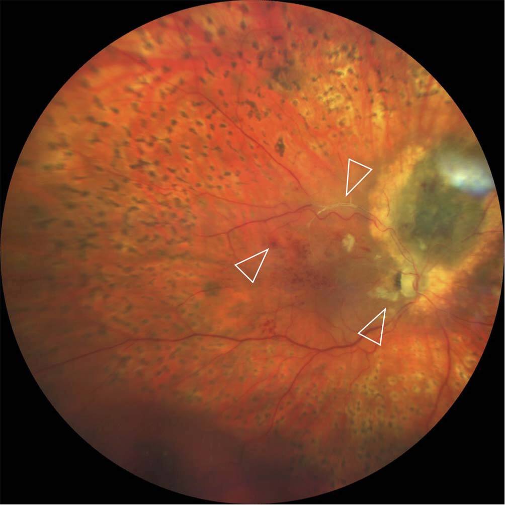 Figure 4. Rétinographie grand champ montrant une papillopathie, une maculopathie et une rétinopathie radiques, avec un gros tronc vasculaire occlus (flèches) ainsi qu’une PPR laser complète, réalisée en prévention d’un glaucome néovasculaire en raison de l’irradiation des gros troncs vasculaires.
