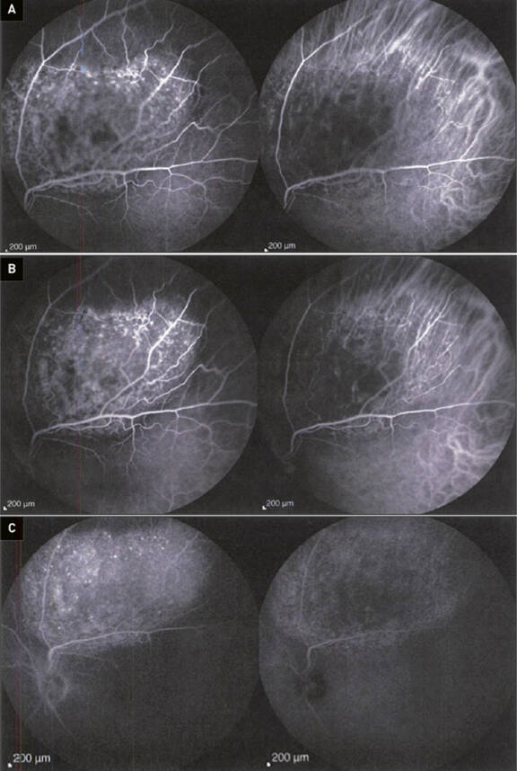 Figure 4. Angiographie à la fluorescéine (à gauche) et angiographie ICG (à droite) aux temps précoce (40 secondes), intermédiaire (4 minutes) et tardif (10 minutes) de haut en bas (avec l’aimable autorisation du Dr Delhay, Cap’Ophta Vannes).
