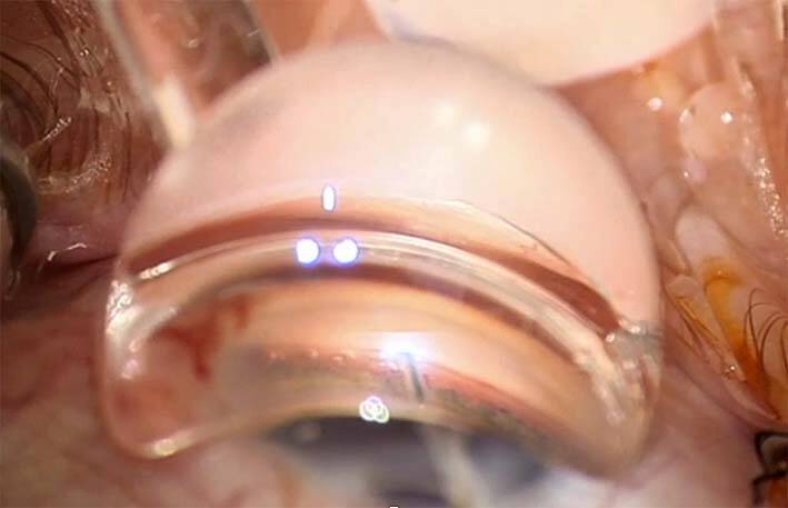 Figure 5. Visualisation du faisceau laser excimer lors du geste chirurgical.
