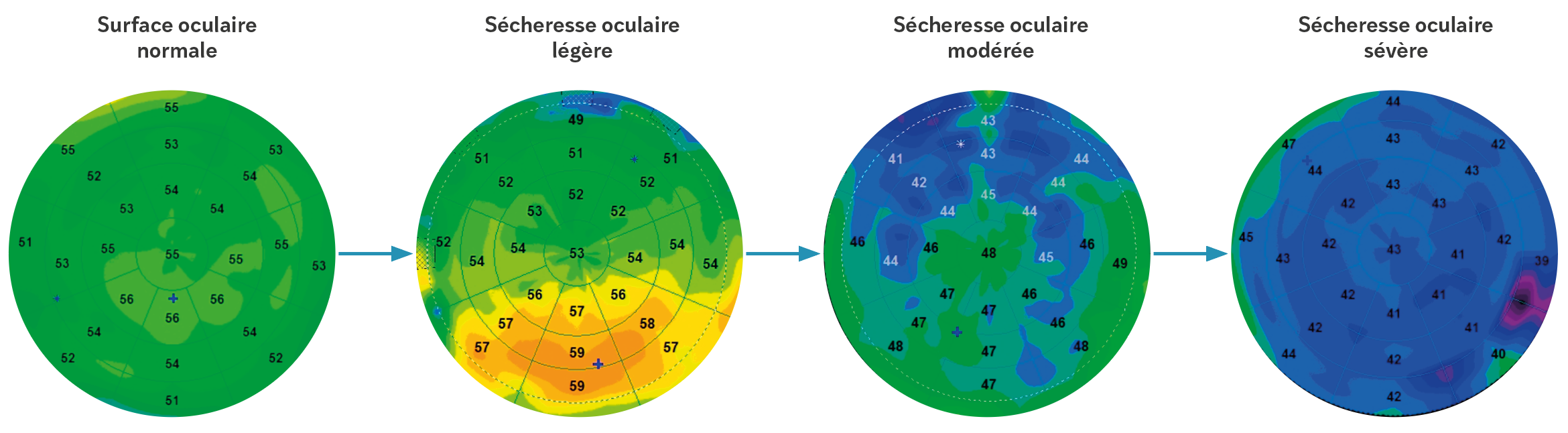 Figure 1. Proposition de classification de la sécheresse oculaire à partir des cartographies épithéliales.
