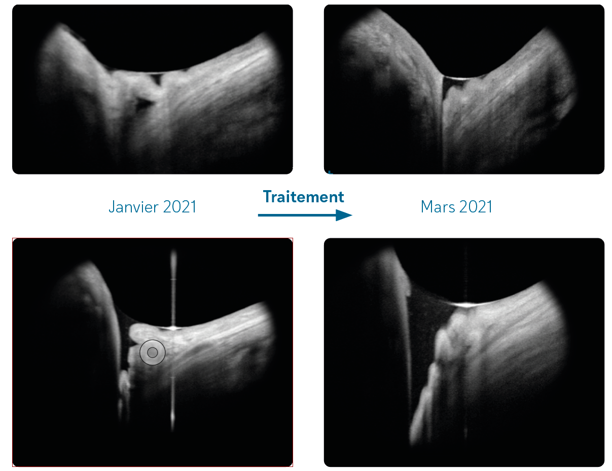 Figure 6 B. L’analyse du ménisque lacrymal inférieur du patient de la figure 6A montre, après traitement, une diminution des plis de conjonctivochalasis responsable d’un comblement du ménisque de larmes et permettant la réapparition d’un certain volume basal.

