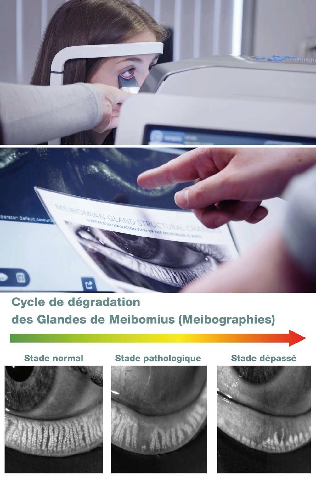 Figure 2. Meibographie et présentation de l’imagerie au patient.
