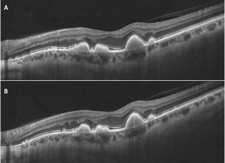 Figure 2. Patient de 68 ans avec une DMLA intermédiaire du côté gauche. A. Épaisseur choroïdienne initiale avant PBM (173 microns). B. Épaisseur choroïdienne 4,1 mois après (164 microns). À noter une très discrète diminution de la taille des drusen.
