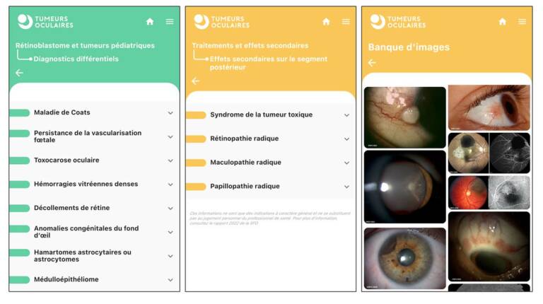 Figure 9. App « Tumeurs oculaires ». Rubriques « Rétinoblastome et tumeurs pédiatriques », « Traitements et effets secondaires » et « Banque d’image » qui permet de valoriser le format Atlas du rapport et de l’application.
