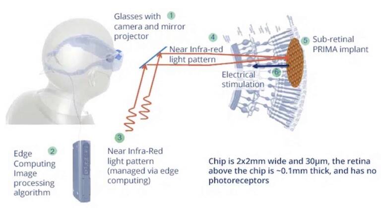 Figure 3. Schéma de fonctionnement du système de vision bionique PRIMA (Pixium Vision). Il s’agit d’un système d’implant sous-rétinien photovoltaïque sans fil.&nbsp;Source : Pixium-vision.com
