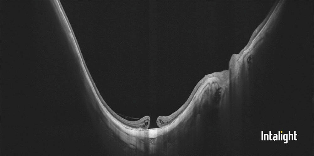 Figure 6. Trou maculaire au fond d’un staphylome, Dream OCT d’Intalight avec profondeur de 12 mm montrant bien l’importance du staphylome.
