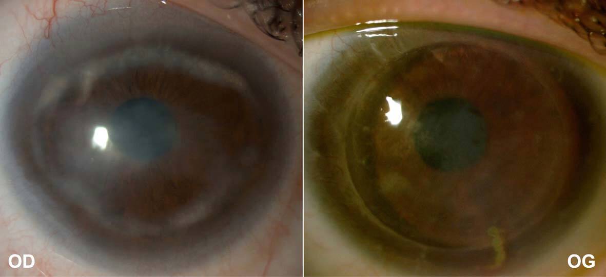 Figure 2. Séquelles d’une kératite à Pseudomonas aeruginosa à 5 ans, avec kératoplastie lamellaire de l’œil gauche.
