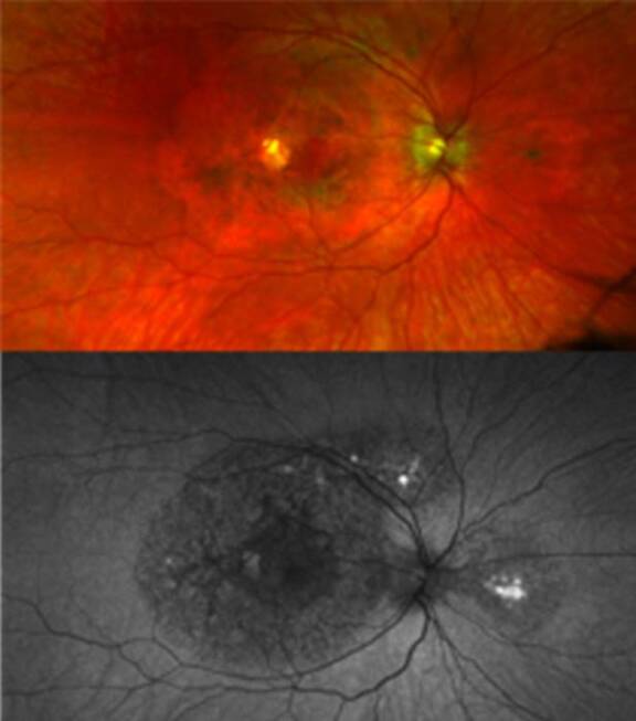 Images d’un patient avec mutation de TIMP3 causant des symptômes atypiques : des dommages maculaires sont visibles dans la rétine (les cercles sombres) mais il n’y a pas de néovascularisation choroïdienne.
Crédit : National Eye Institute
