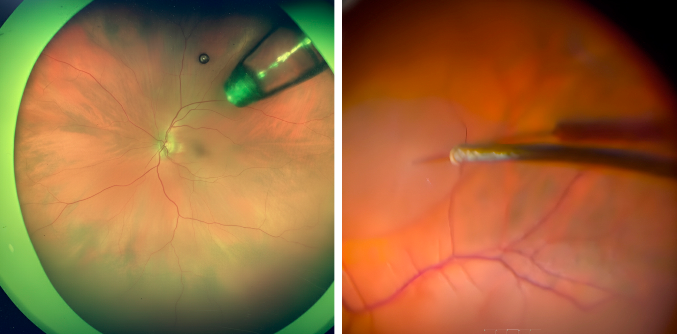 A gauche : Implant PDP implanté dans le cadre du protocole VELODROME — patient du centre Monticelli/clinique Juge. A droite :Injection sous-rétinienne dans le cadre du protocole ASCENT — patient du centre Monticelli/clinique Juge.
