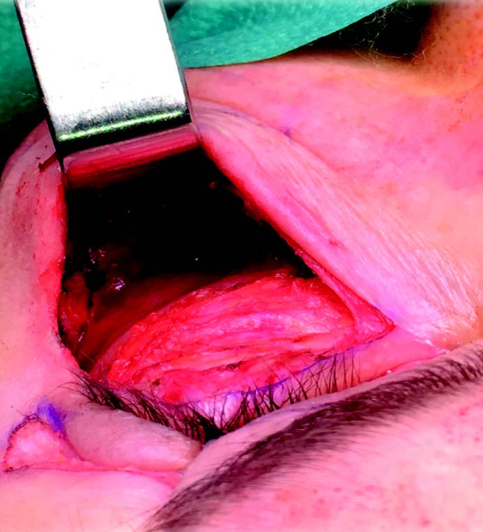 Figure 9. Décollement sous-périosté.
