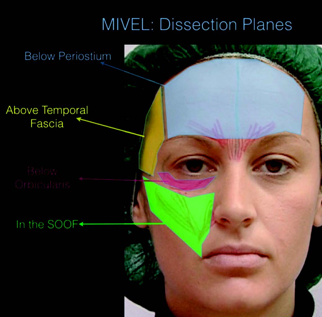 Figure 4. Zones de dissection.
