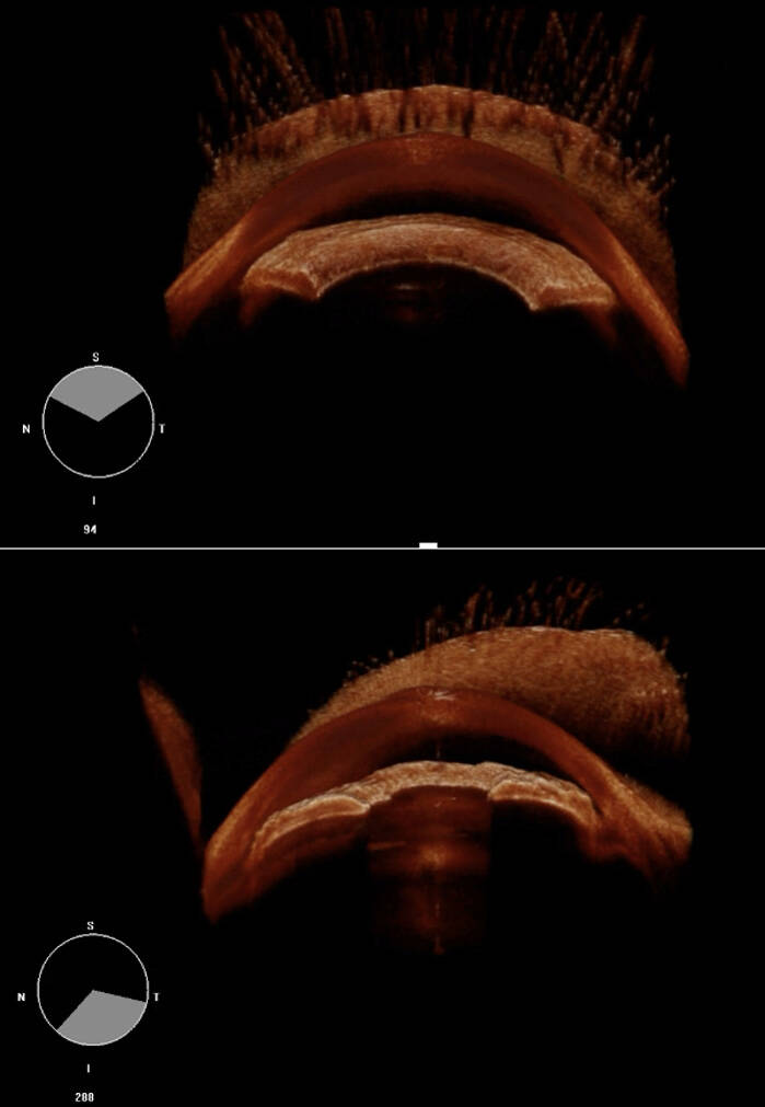 Imagerie tri-dimensionnelle du segment antérieur de l’œil en OCT-Swept source. En haut. Iris plateau montrant un angle iridocornéen en bec de flute et sans synéchies. En bas. &nbsp;Nanophtalmie avec convexité irienne importante, angle iridocornéen étroit en temporal sans synéchie et synéchie iridotrabéculaire en nasal inférieur.
