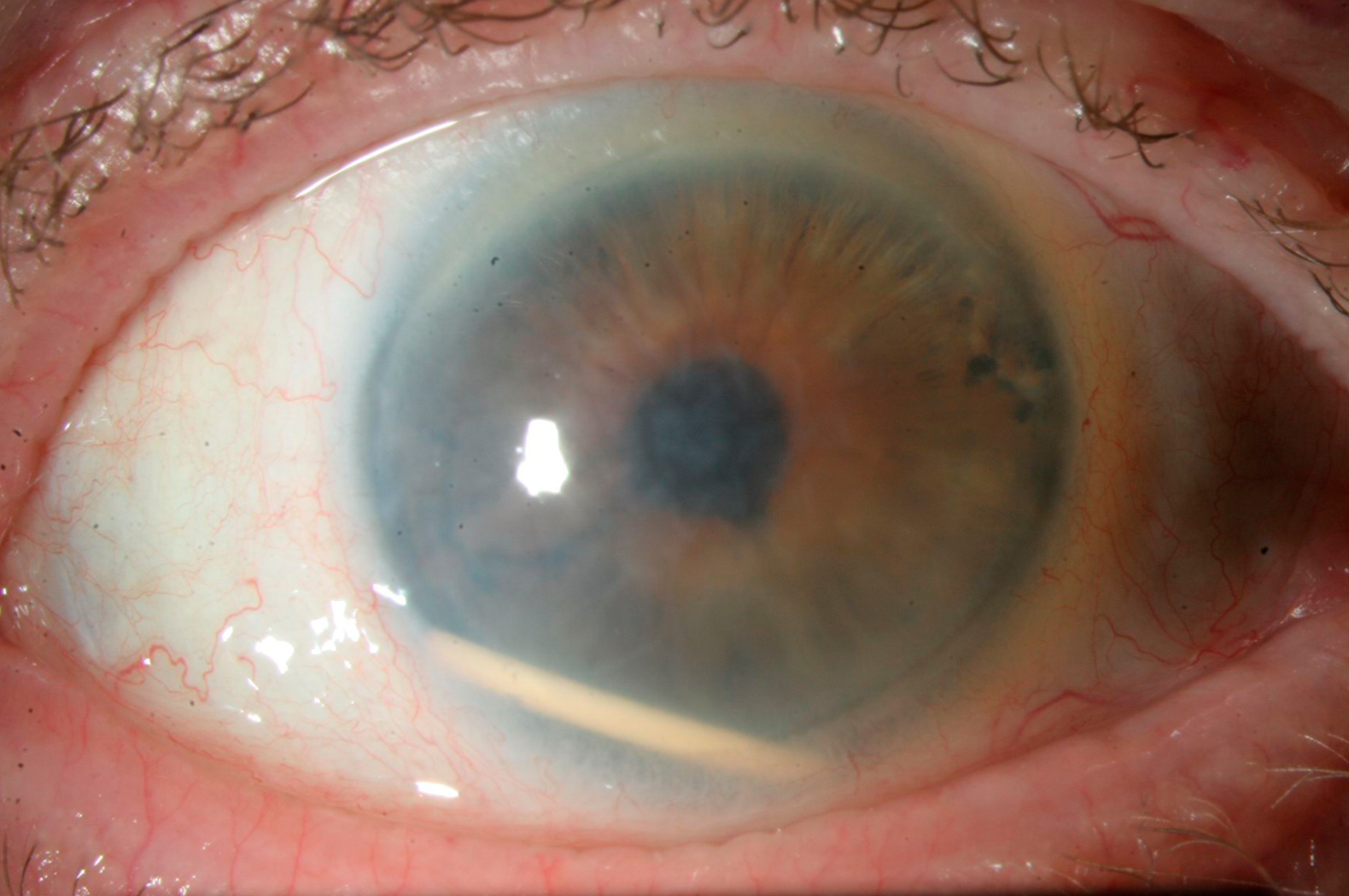 Figure 1. Migration en chambre antérieure par défaut de plan zonulaire postérieure.
