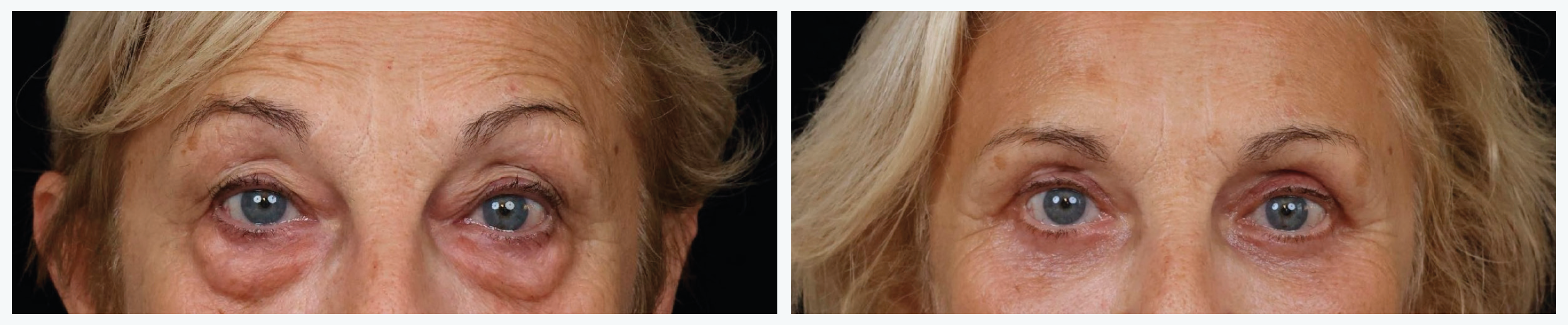 Figure 3. A gauche, patiente de 67 ans ayant eu à 40 ans une réduction par voie sous-ciliaire, avec récidive des poches en quelques années. A droite, résultat 4 mois après une blépharoplastie supérieure avec transposition, correction de ptosis, et blépharoplastie inférieure transconjonctivale avec transposition des poches de graisse. Pas de lipostructure associée.
