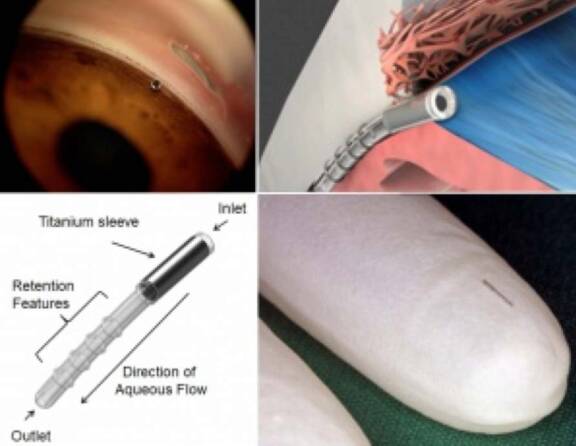 Figure 6. iStent supra : drain tubulaire inséré à la racine de l’iris.
