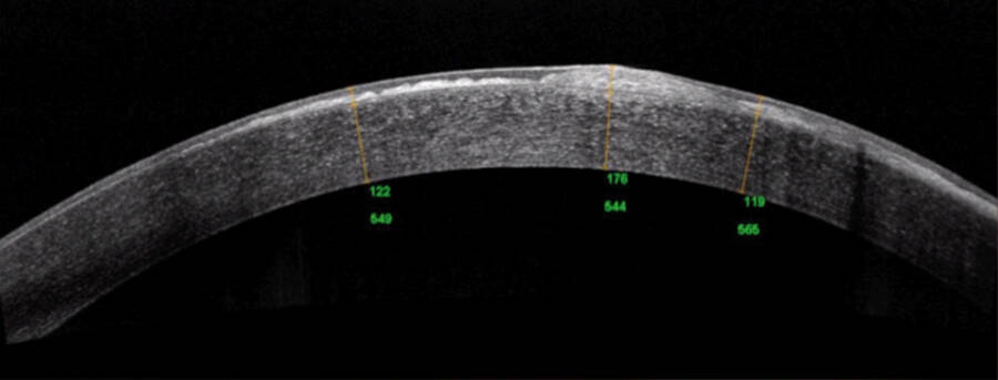 Figure 2. OCT préopératoire de l’œil gauche.
