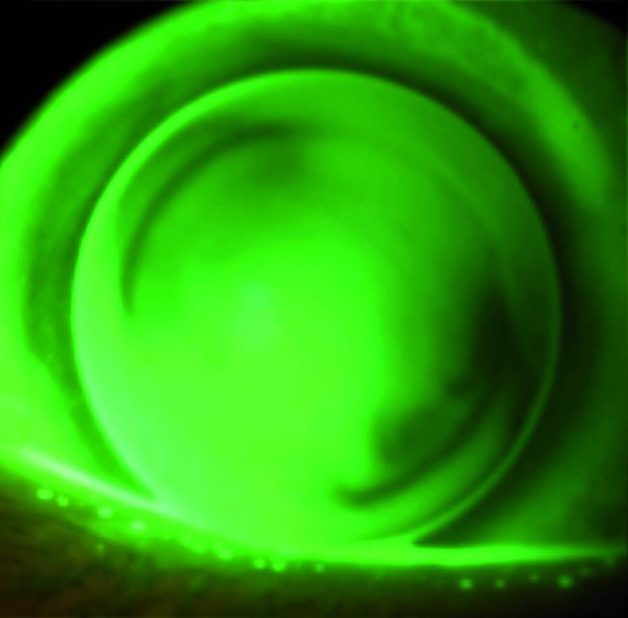 Figure 3. Image fluo en sablier d’une lentille sphérique sur une cornée torique. Si le confort de port et l’acuité sont satisfaisants, cette adaptation est tout à fait acceptable.
