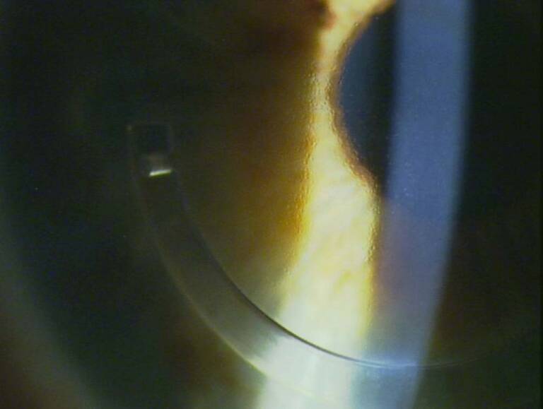 Figure 1. Image de cornea guttata dense associée à un anneau intracornéen posé pour un kératocône.
