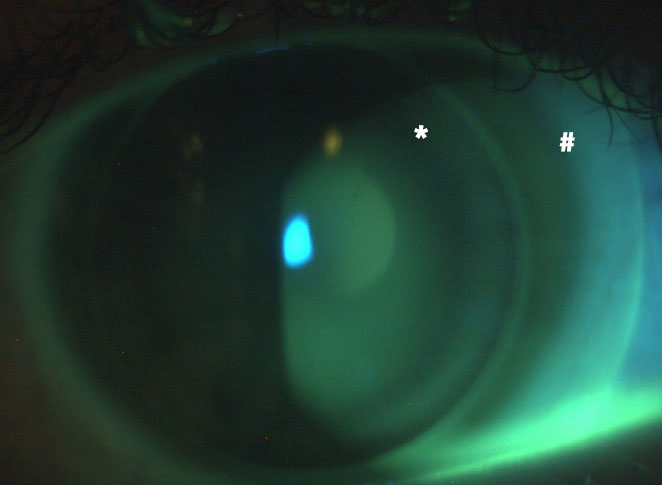 Figure 5. Examen biomicroscopique de l’œil droit après instillation de fluorescéine et utilisation d’un filtre jaune. La lentille rigide (*) est posée sur une lentille souple journalière en silicone hydrogel (#).

