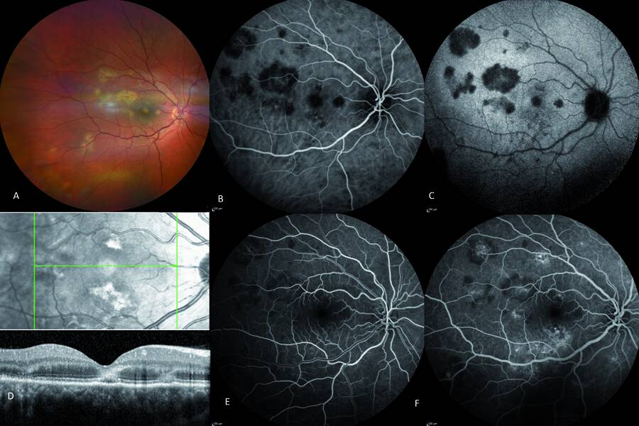 Figure 2. Épithéliopathie en plaques avec atteinte fovéolaire de l’œil droit : les lésions jaunes sont visibles en rétinophotographie (A) et typiques en OCT (D) : interruption de la zone ellipsoïde et de la membrane limitante externe, hyperréflectivité de la couche nucléaire externe. La non-perfusion de la choriocapillaire est visible hypofluorescente dès les phases précoces de l’angiographie à l’ICG (B) et à la fluorescéine (E), et persiste au temps tardif de l’ICG (C). Remplissage progressif rétinien au temps tardif en fluorescéine (F).
