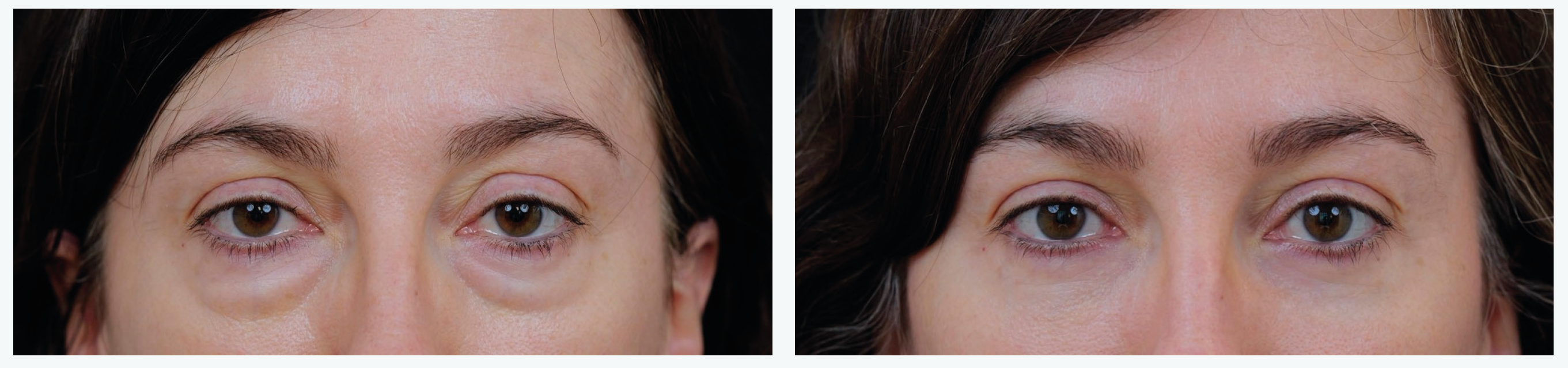 Figure 2. A gauche, patiente de 46 ans, poches et cernes creux sur un vecteur maxillaire négatif, ptosis bilatéral répondant à 2 gouttes de néosynéphrine. A droite, résultat à 3 mois après microfat palpébral supérieur et malaire, réduction conjonctivo-mullérienne de 7 mm et blépharoplastie inférieure de préservation par transposition transconjonctivale avec fixation interne.
