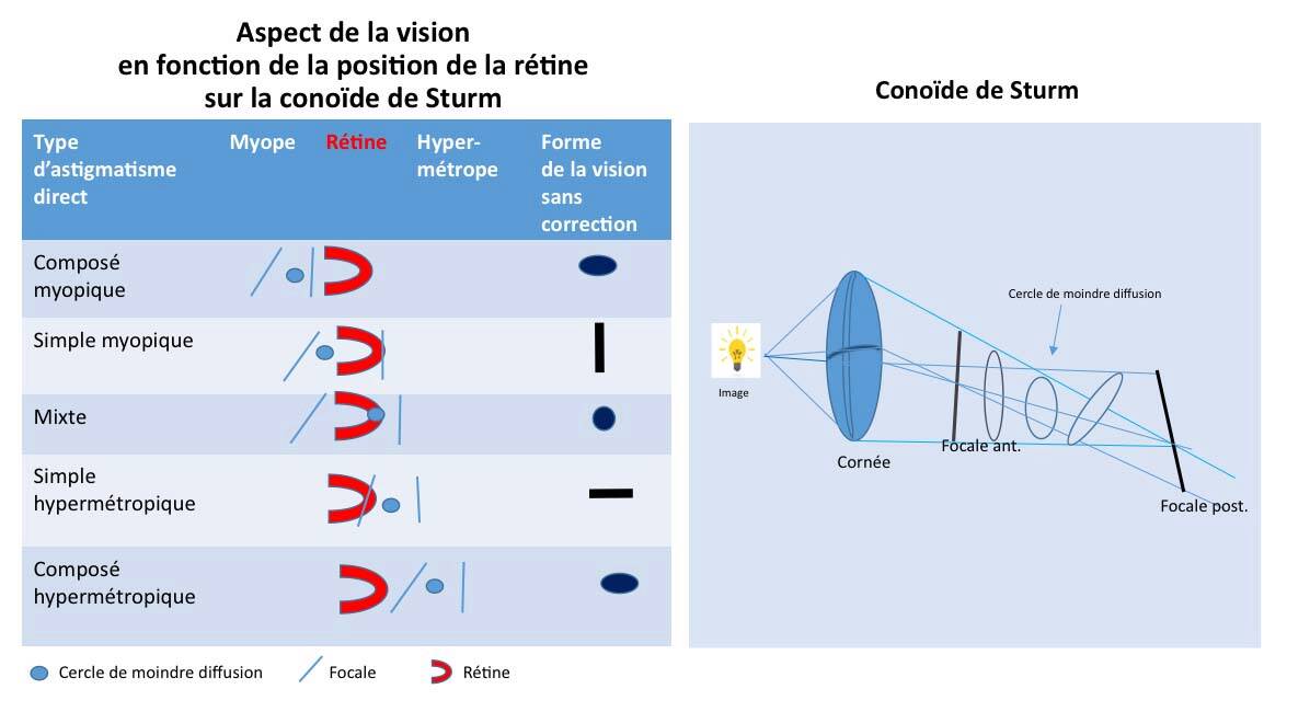 Figure 3. Aspect de la vision de l’astigmate en fonction de la position des focales images par rapport à la rétine. Représentation de la conoïde de Sturm.&nbsp;
