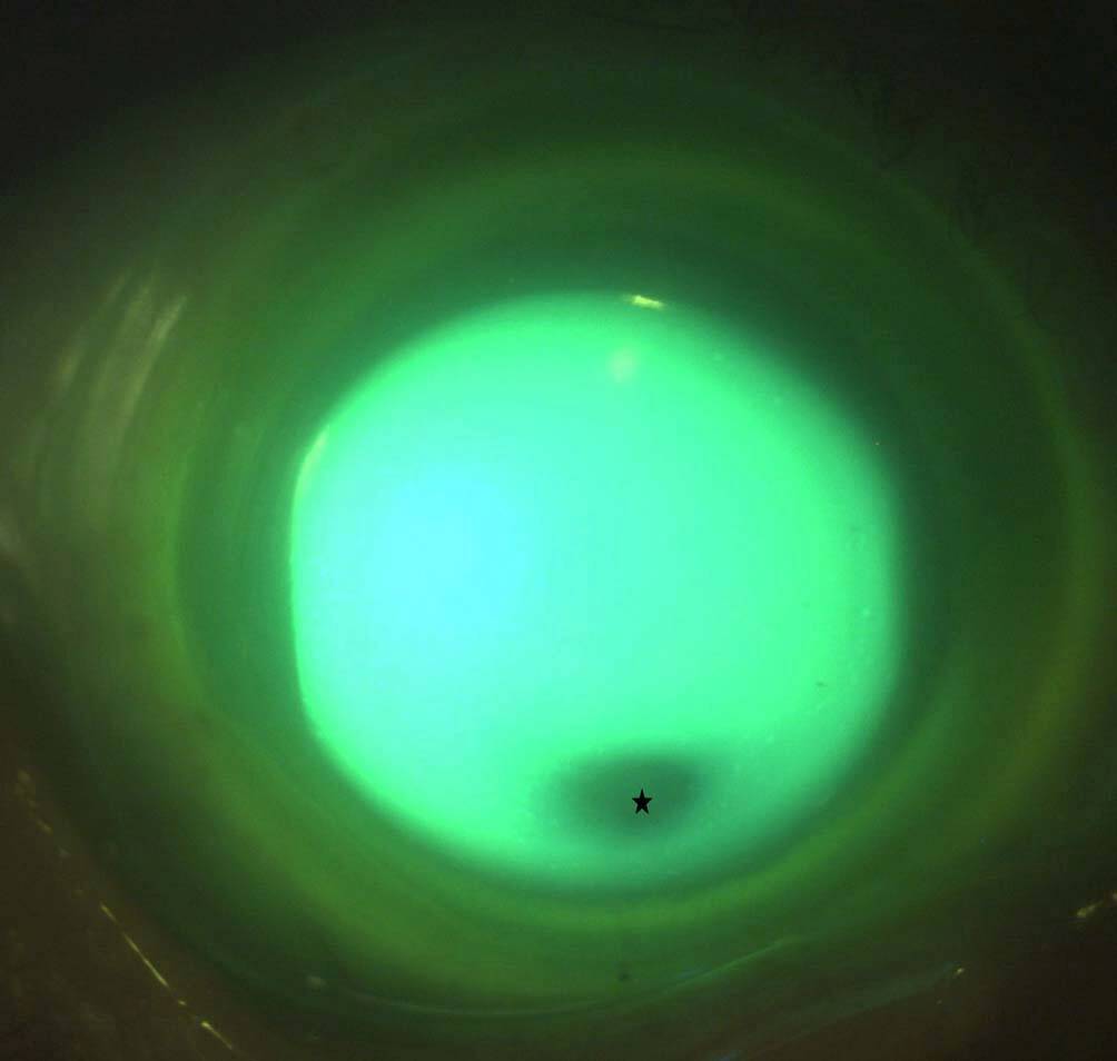 Figure 6. Examen en lumière bleue. Il existe un contact entre la lentille et la cornée au niveau de la zone sans fluorescéine.
