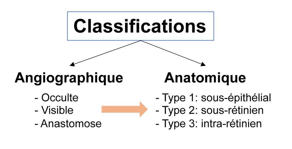 Figure 1. Modification de la classification des néovaisseaux. D’une classification angiographique, l’apport de l’imagerie multimodale a permis d’évoluer vers une classification anatomique.
