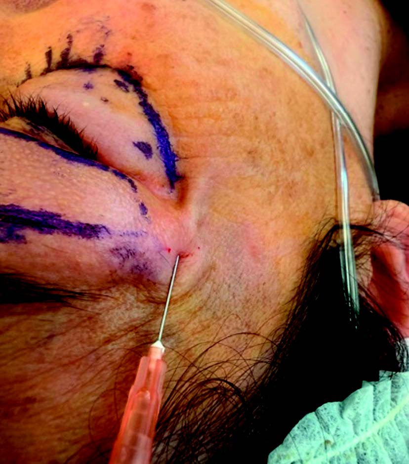 Figure 7. Bloc zygomatico-facial.
