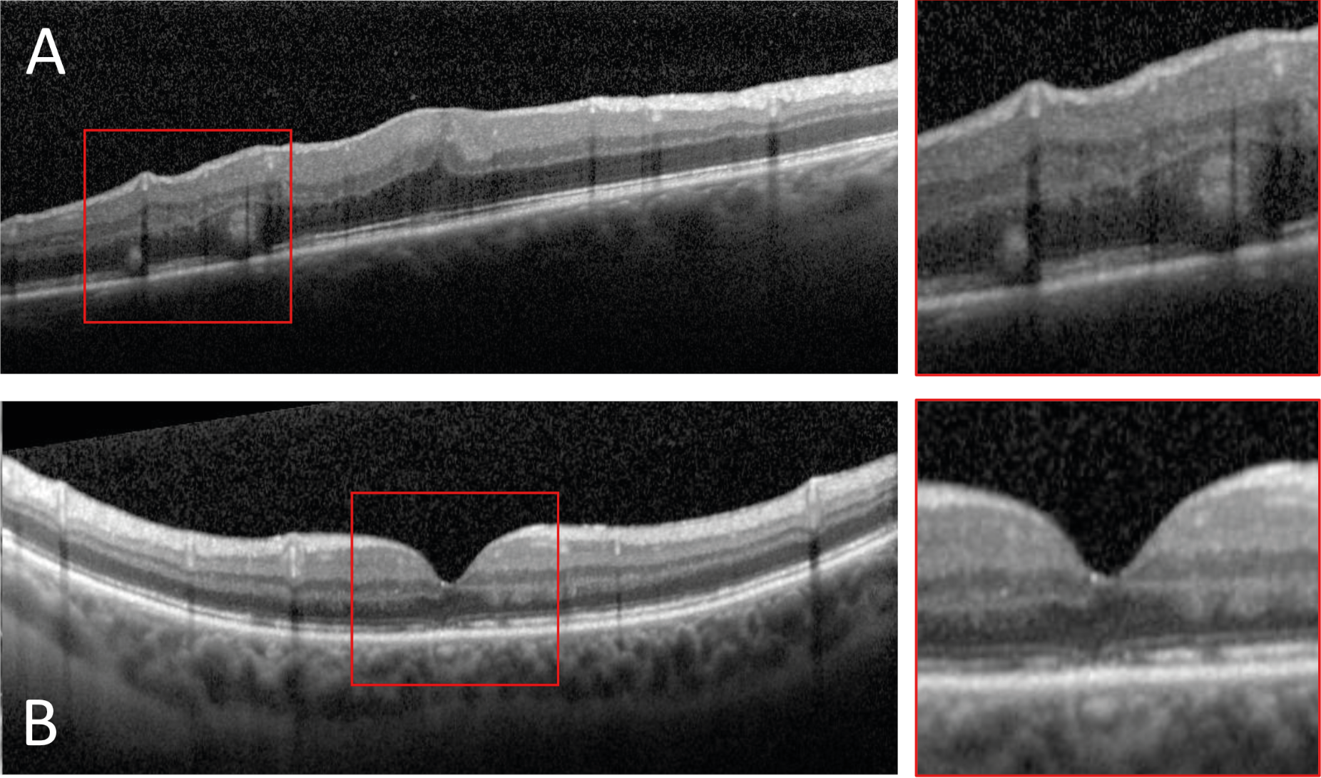 Figure 2. Exemples illustrant une réapplication de moindre intégrité selon Muni et al. OCT maculaire montrant des plis de la rétine externe (A) et des altérations de la membrane limitante externe, de la zone ellipsoïde et de la zone d’interdigitation (B).
