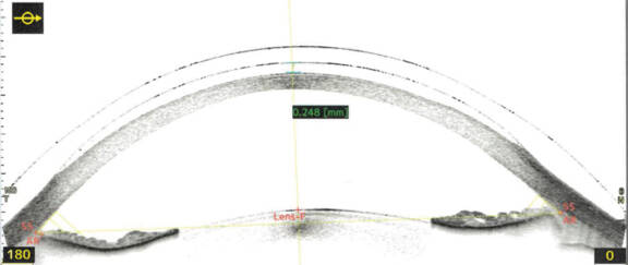 Figure 2. Coupe 0/180° en OCT Spectral Domain de l’œil droit avec la lentille sclérale montrant l’espace liquidien entre la face postérieure de la lentille et la cornée, avec mesure de la clairance cornéenne centrale à 248 µ.
