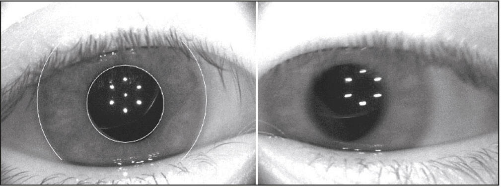 Figure 1. Luxation bilatérale des cristallins chez un enfant de 4 ans chez qui le diagnostic de syndrome de Marfan sera confirmé génétiquement. La vision avec correction était limitée à 2/10, avec une myopie d’origine cristallinienne et axile de -14 D et un cylindre de -8. La vision après extraction complète du sac/cristallin et adaptation en lentilles rigides de +19 et +21 est de 10/10 ODG.
