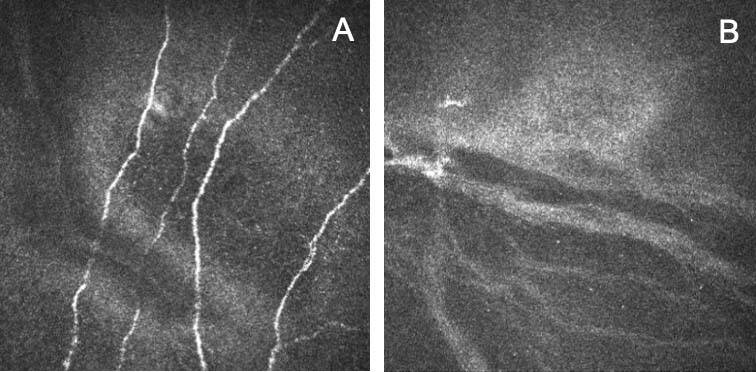 Figure 3. Images en microscopie confocale du plexus nerveux sous-basal chez un patient avant chirurgie (A) et à 1 mois (B) après un Lasik. La densité de l’innervation est inférieure à 1 mois par rapport à celle retrouvée après un Smile. 
