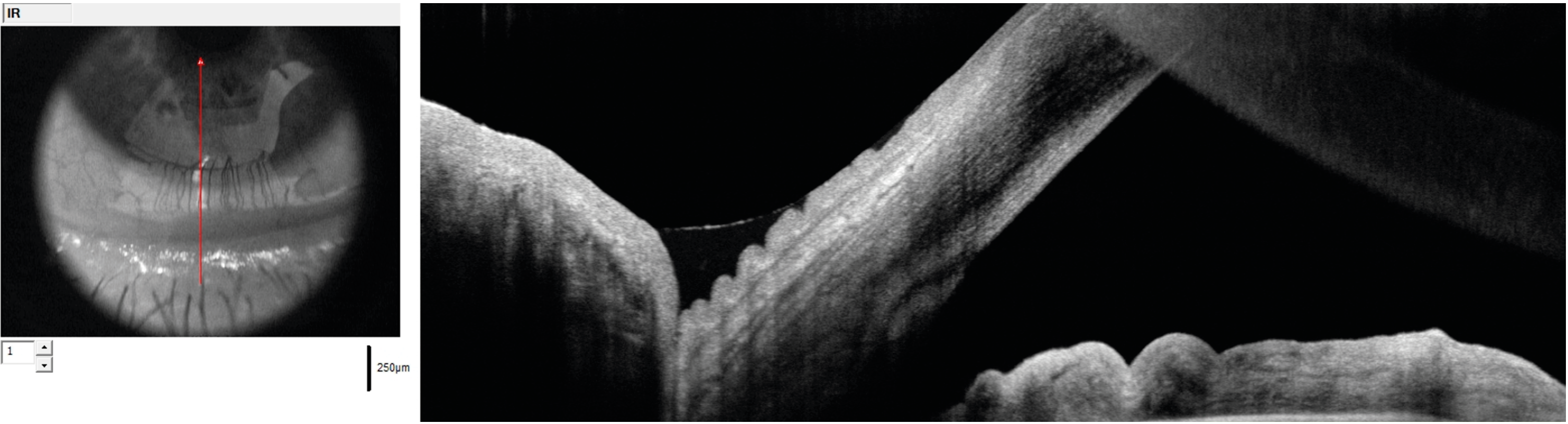Figure 2. Imagerie OCT B-scan du ménisque de larmes inférieur volumineux associé à des plis de conjonctivochalasis.
