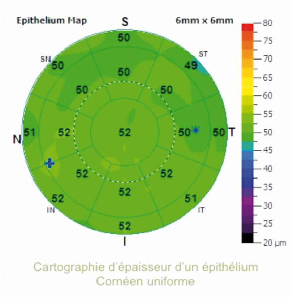 Figure 1.&nbsp; Epithelial mapping in a patient with a normal ocular surface. The corneal epithelium is slightly thinner in the upper regions than in the lower regions, and thicker in the nasal region than in the temporal region.
