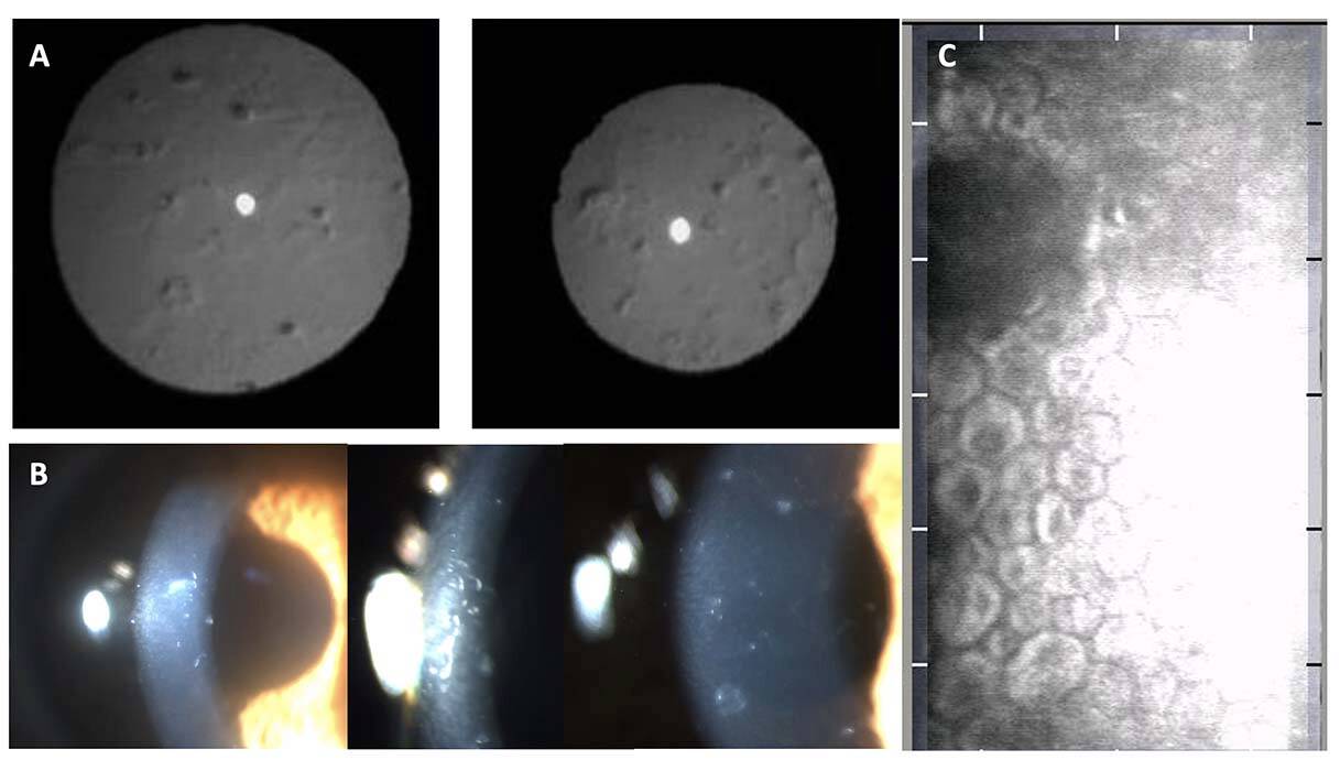 Figure 16. La dystrophie postérieure polymorphe est particulièrement bien visible sur l’image de rétro-illumination infrarouge par rapport à l’image de lampe à fente (B) ou de microscopie spéculaire (C).
