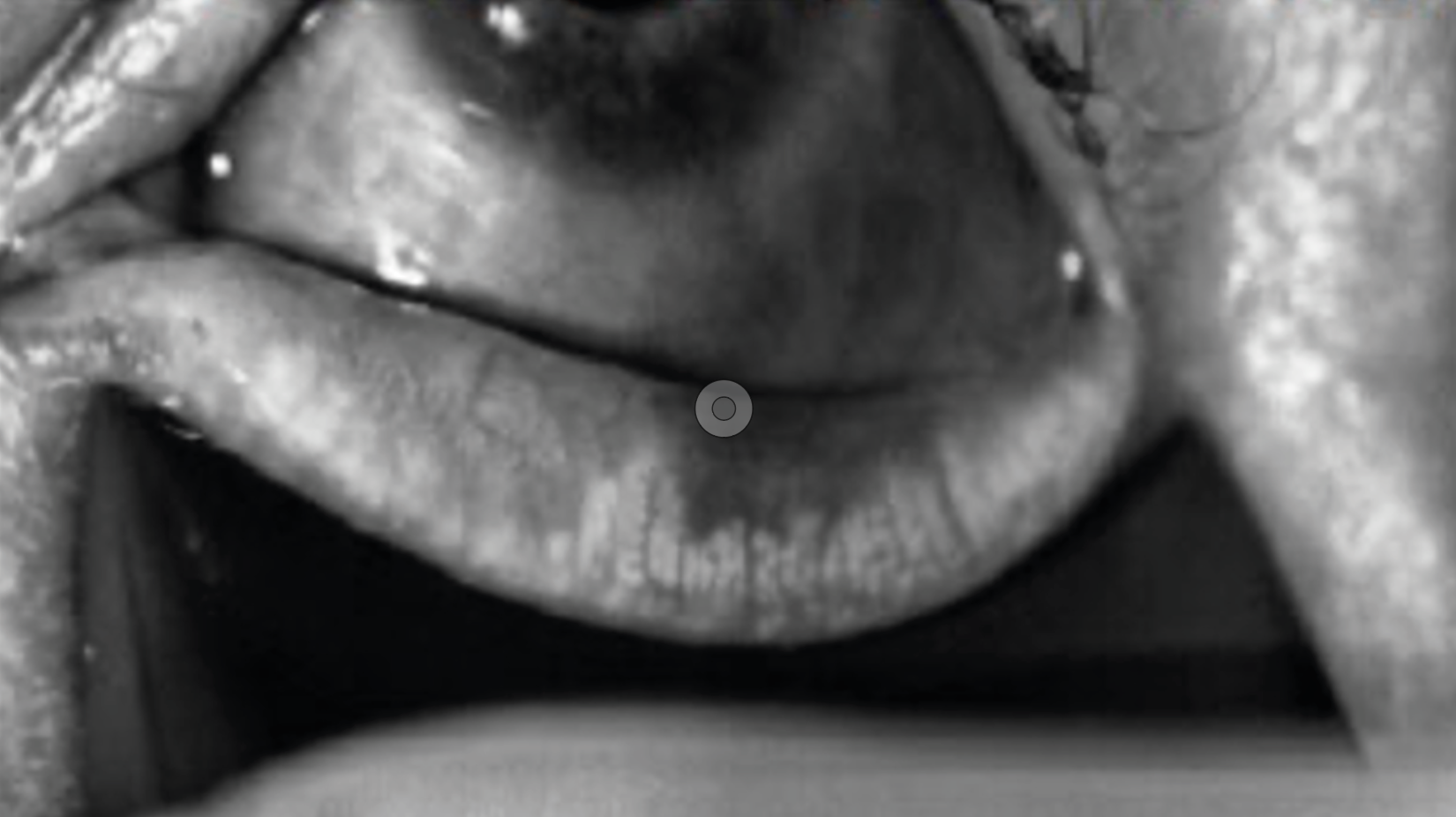 Figure 3. Meibographie
