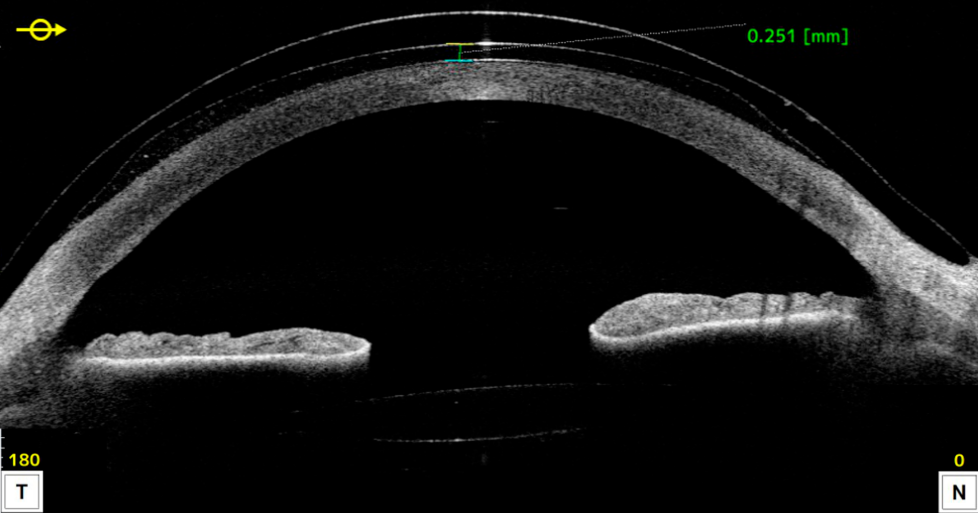 Figure 1. Coupe OCT horizontale avec la lentille sclérale AKS (CASIA, Tomey). Mesure en OCT du réservoir liquidien. Quelques dépôts hyperréflectifs sont visibles.

