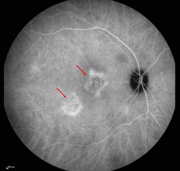 Figure 1. Angiographie au vert d’indocyanine au temps intermédiaire d’un patient de 45 ans atteint d’une CRSC récidivante de son œil droit. Les plages d’hyperméabilité vasculaire choroïdienne sont bien visibles (flèches rouges).
