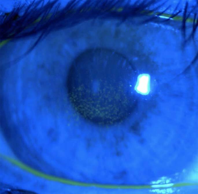 Figure 2. Sécheresse post-Lasik hypermétropique.
