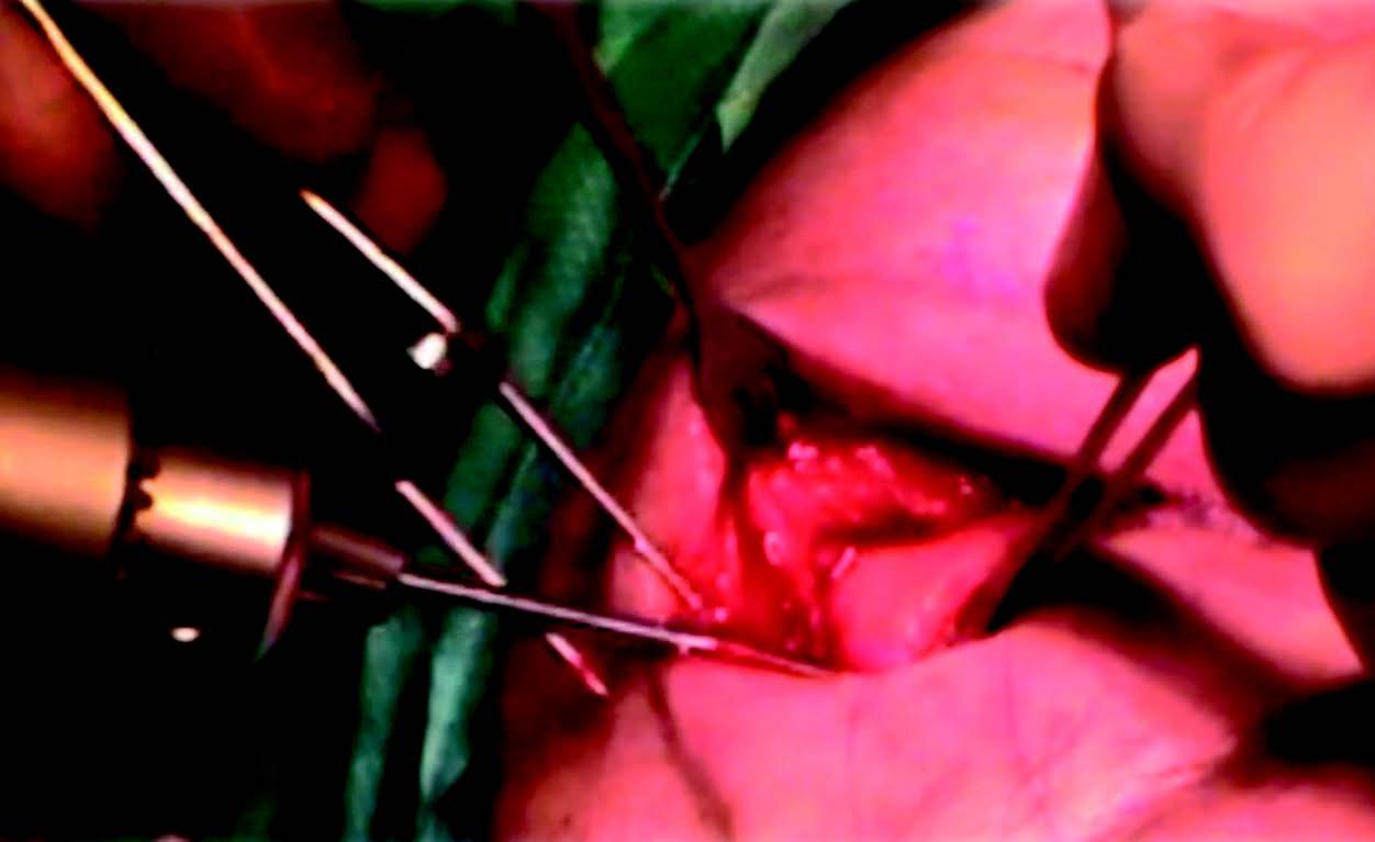 Figure 10. Fixation transosseuse.
