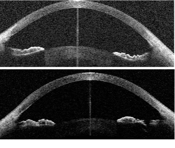 Figure 5. Syndrome de dispersion pigmentaire avant et après une iridotomie laser. Avant une iridotomie, noter l’aspect de recurvatum irien avec apposition de l’épithélium pigmenté irien contre les zonules cristalliniennes.&nbsp;
