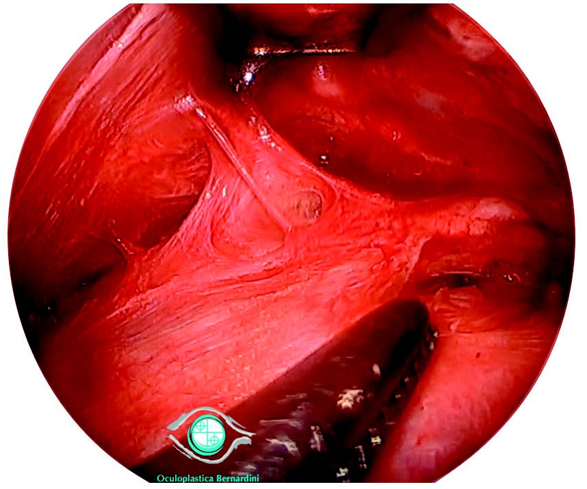 Figure 6. Dissection endoscopique 
temporale.
