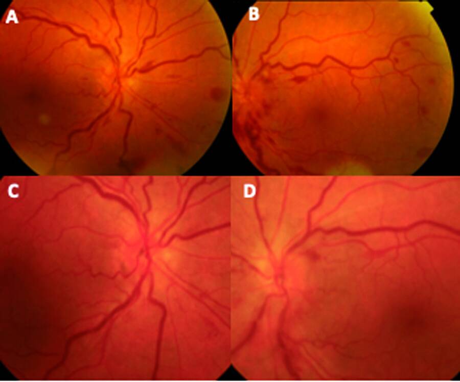 Figure 3. Rétinographie œil droit (A) et gauche (B) chez un patient présentant une rétinopathie liée à l’hyperviscosité prédominant œil gauche dans le cadre d’une maladie de Waldenström avec tortuosité veineuse bilatérale, hémorragies en flammèches et en « taches », et un œdème papillaire œil gauche. Aspect œil droit (C) et œil gauche (D), 12 jours après plasmaphérèse : régression de la rétinopathie liée à l’hyperviscosité aux 2 yeux.
